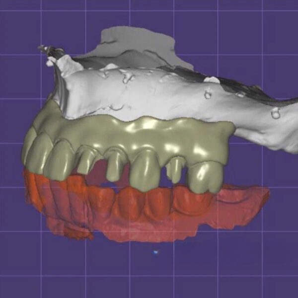 All-on-4 implant design with prosthetic-driven planning CAD/CAM digital file ready for production