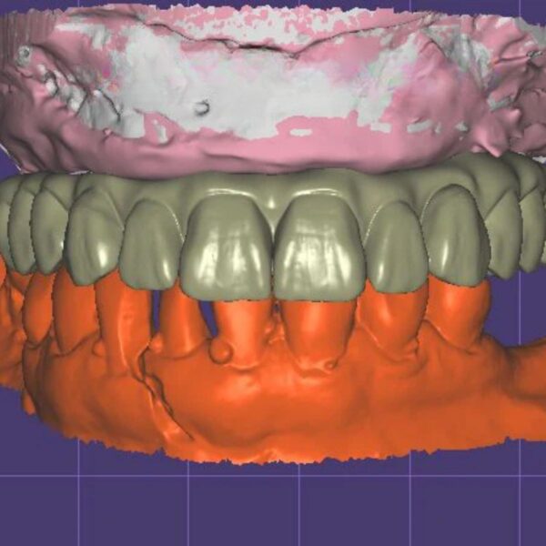 All-on-X implant design with multiple implant configurations CAD/CAM digital file ready for production