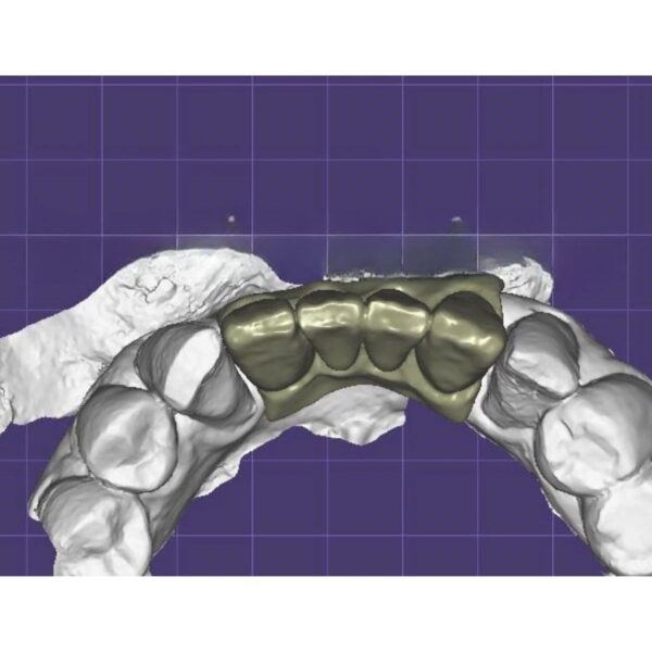 Cement retained implant bridge design with custom abutments CAD/CAM digital file ready for production
