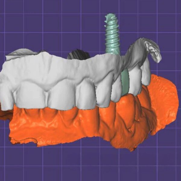 Cement retained implant crown design with custom abutment CAD/CAM digital file ready for production