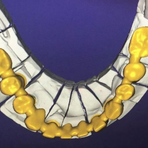 Professional dental bridge coping design CAD framework showing precise margin fit and optimal thickness distribution