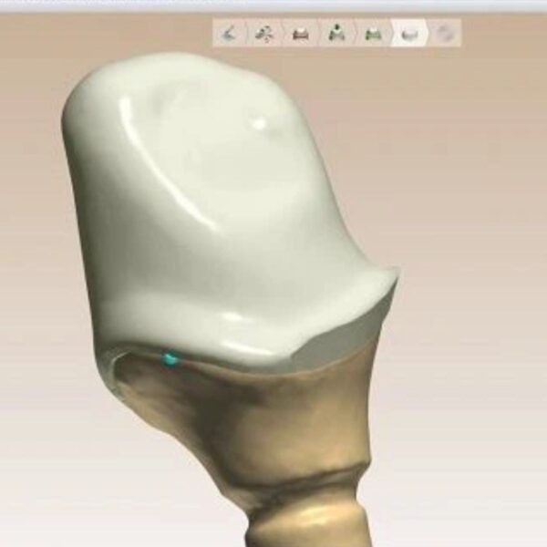 Professional dental crown coping design CAD framework showing optimal thickness and precise margin fit