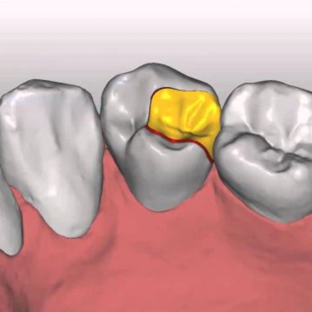 dental-inlay-design-cad-conservative-service Professional dental inlay design CAD file showing precise conservative restoration with optimal marginal fit