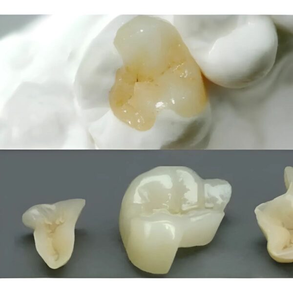 Professional dental onlay design CAD file showing conservative restoration with optimal cusp coverage and fit