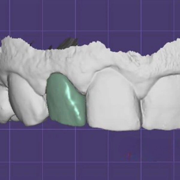 Professional full anatomy crown design CAD file showing optimal zirconia thickness and natural tooth morphology