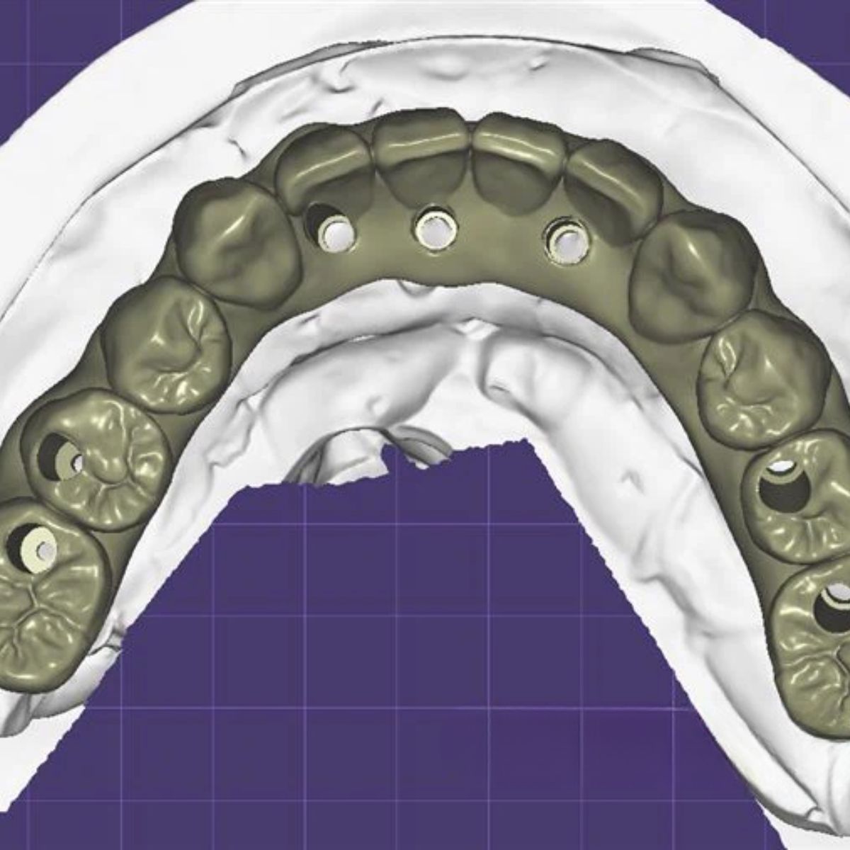 screw-retained-implant-bridge-design-cad Screw retained implant bridge design with titanium bases CAD/CAM digital file ready for milling