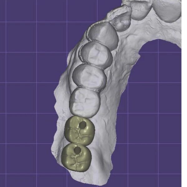 Screw retained implant crown design with titanium base CAD/CAM digital file ready for milling