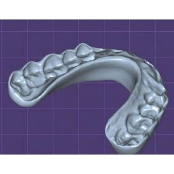 Professional dental splint design CAD file showing custom night guard for bruxism treatment and TMJ therapy